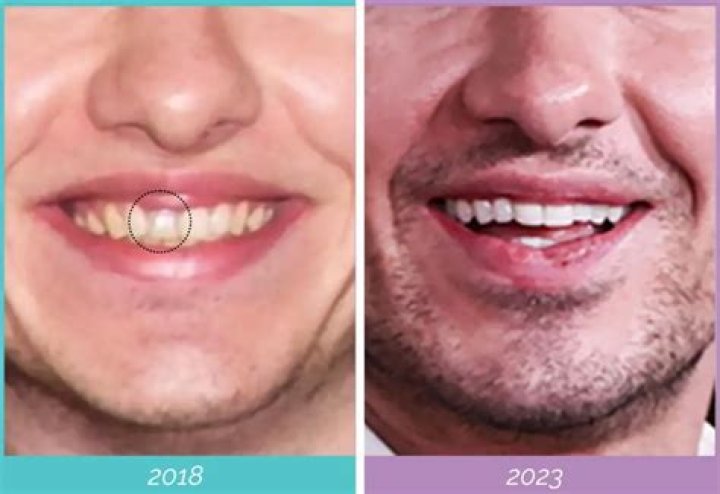 The Truth About Barry Keoghan's Plastic Surgery Speculation