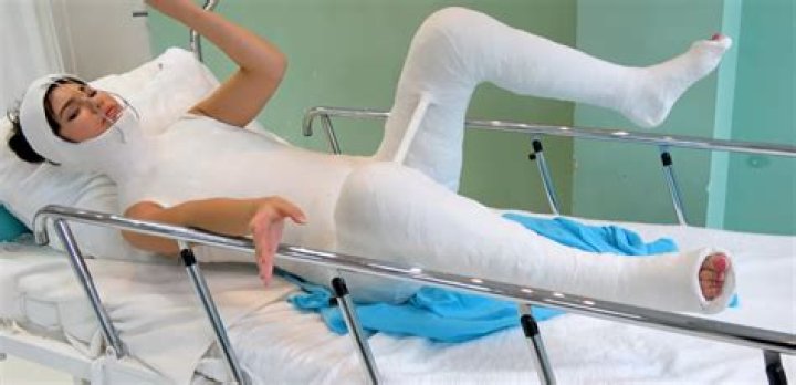 Ultimate Guide To Full Body Casts For Women: Comprehensive Guide