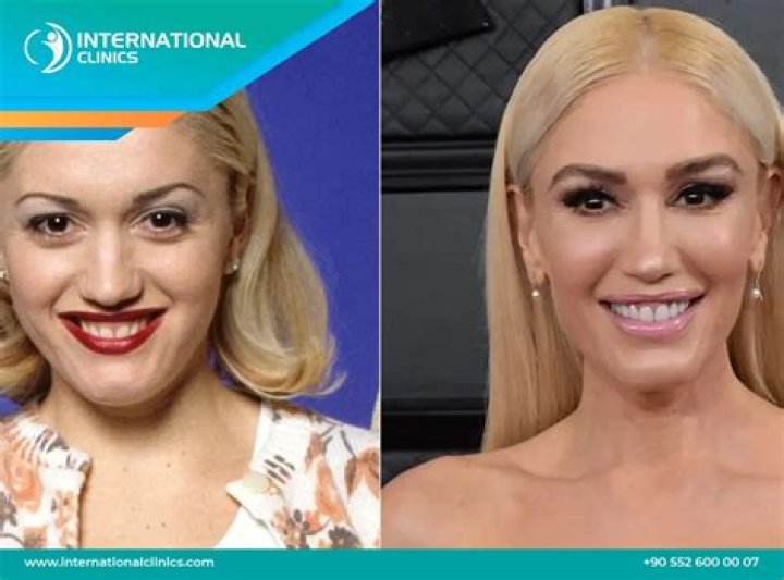 The Ultimate Guide To Gwen Stefani's Iconic Lips: Surgery Secrets Revealed