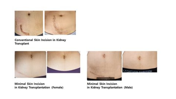 Understanding The Journey Of Kidney Transplant Scars