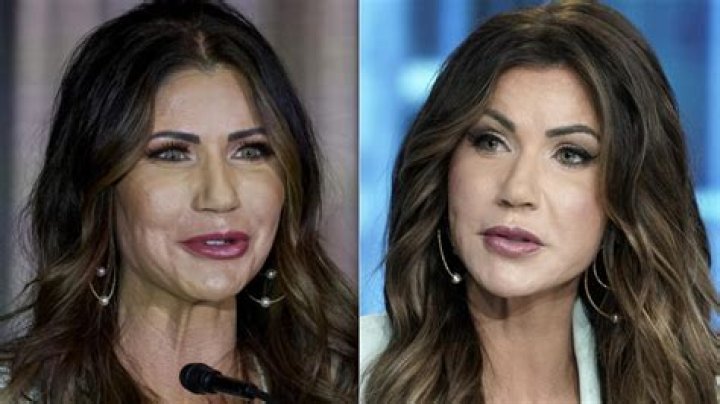Kristi Noem's Face Lift: Before And After Pictures, Cost, And Recovery