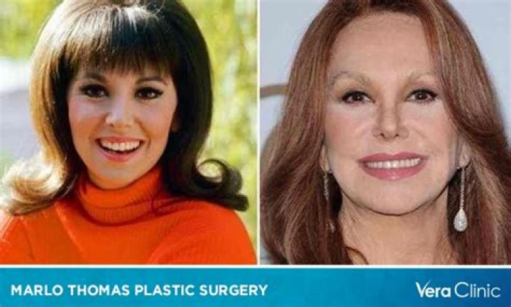 Marlo Thomas Surgeries: Uncovering The Truth