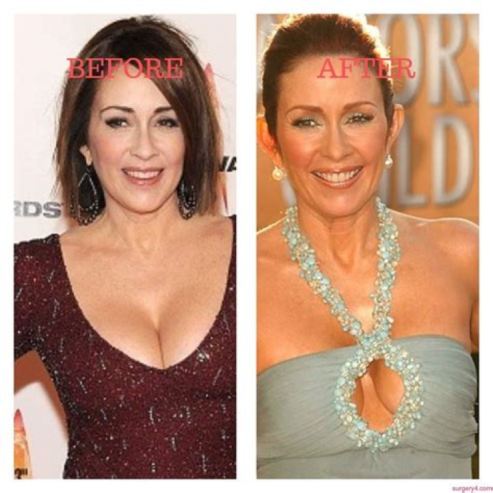 Patricia Heaton's Transformative Plastic Surgery Journey