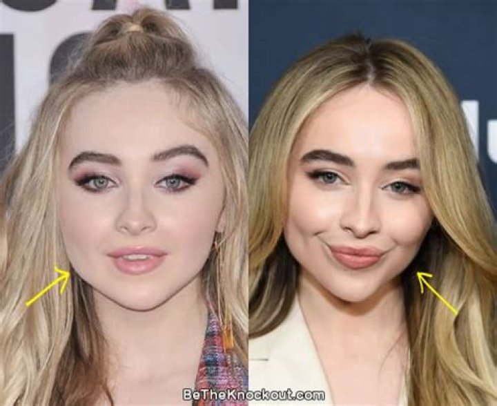Everything You Need To Know About Sabrina Carpenter's Botox Journey